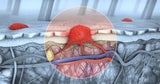 Die Überlebenschancen bei Hautkrebs haben sich deutlich gebessert. Verantwortlich dafür zeichnen moderne Therapien.