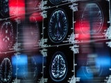 Diese drei Impfungen schützen vor Demenz