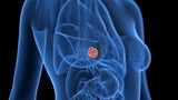 Jede dritte Brustkrebs-Patientin kann auf Chemotherapie verzichten