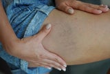 Schöne Sommerbeine: Mit diesen Tipps bleiben Ihre Venen auch im Sommer stark