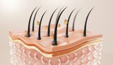 Als Therapie bei genetisch und hormonell bedingtem Haarausfall hat sich das Mittel „Minoxidil“ bewährt. 