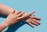 Chronische Entzündung: Aufgrund der gestörten Hautbarriere können Schadstoffe in die Haut eindringen, eine Entzündungsreaktion auslösen und die Symptome verschlimmern. &nbsp;&nbsp;