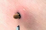 Zecken-Check: Nach einem Aufenthalt im Freien empfiehlt es sich, den Körper und die Kleidung nach Zecken durchzusuchen.&nbsp;&nbsp;