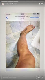 Cora Schumacher zeigt blaue Flecken an Armen und Beinen