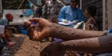 Mpox in Afrika