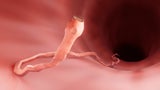 Mann isst Schweinefleisch, dann wimmelt es von Parasiten
