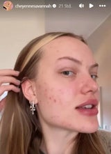 Mutig! Cheyenne Ochsenknecht zeigt ihre Akne