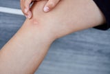 Mückenstich juckt? Dieses einfache Hausmittel hilft sofort