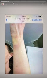 Cora Schumacher zeigt blaue Flecken an Armen und Beinen