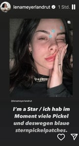 Anne Hathaway, Justin Bieber und Co.: Der Anti-Pickel-Trick der Stars