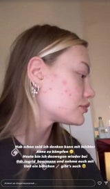 Mutig! Cheyenne Ochsenknecht zeigt ihre Akne