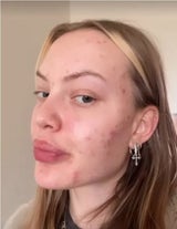 Mutig! Cheyenne Ochsenknecht zeigt ihre Akne