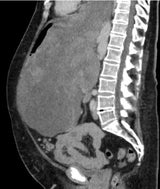 Tumor Bremen