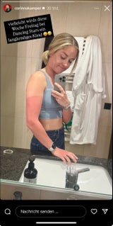 Corinna Kamper hat einen heftigen Sonnenbrand