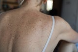 Hautkrebs: Diese neue Therapie verspricht Heilung!