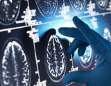 Alzheimer Medikament