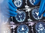 Neue Alzheimer-Hoffnung: Was das neue Medikament kann und für wen es geeignet ist