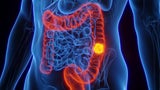 Schockierende Hinweise in Studie: Marathonläufer könnten hohes Risiko für diesen Krebs haben