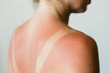 Schnelle Hilfe bei Hautproblemen: SOS-Guide für den Sommer