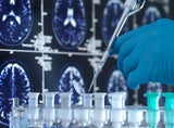 Alzheimer Medikament