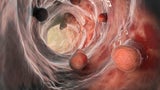 Entzündete Darmwand: Fakten & Therapien