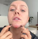 Pickel nach 1,5 Jahren ausgedrückt