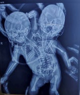 Baby mit zwei Köpfen geboren