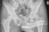 Urology Case Reports