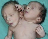 Baby mit zwei Köpfen geboren