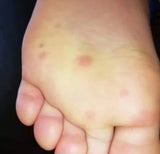 Blaue Flecken könnten auf Corona-Infektion hindeuten