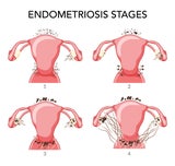 Endometriose: Ein Überblick