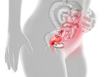 Endometriose: Ein Überblick