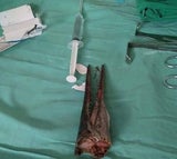 Hornhecht bohrt sich durch Hals eines 16-Jährigen