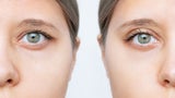 Oberlidstraffung: Behandlung von Sichtfeldeinschränkungen & dem „müden Blick“