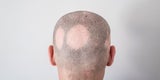 Haarausfall: Symptome, Ursachen und Behandlung