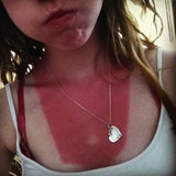 Britin schockt mit brutalstem Sonnenbrand aller Zeiten