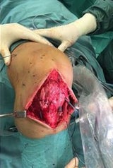 Anna Veith zeigt Schock-Foto von Knie-OP