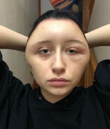 Sie färbt sich die Haare, dann bläht sich Gesicht auf