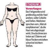 LIPÖDEM-Stadien