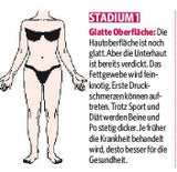 LIPÖDEM-Stadien