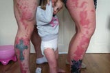Birthmark Baby