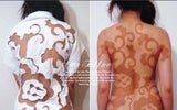 Sonnenbrand-Tattoo