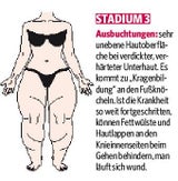 LIPÖDEM-Stadien