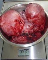 Frau hat 22 Kilo schweren Mega-Tumor