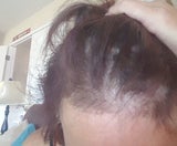 Promi-Shampoo verursacht Haarausfall