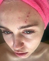 Miley Cyrus: Von der Katze zerkratzt