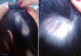 Promi-Shampoo verursacht Haarausfall