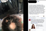 Promi-Shampoo verursacht Haarausfall