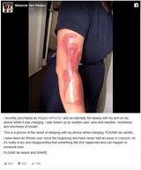 iPhone 7 verbrennt Frau den Arm