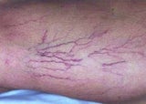 5 Laserbehandung bei Couperose Hernuss